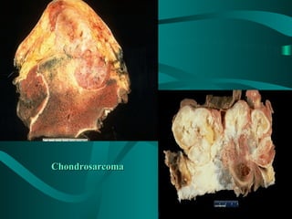 Chondrosarcoma
 