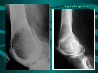 Soap bubble appearance
 