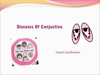 Diseases Of Conjuctiva
Amal Sasikumar
 