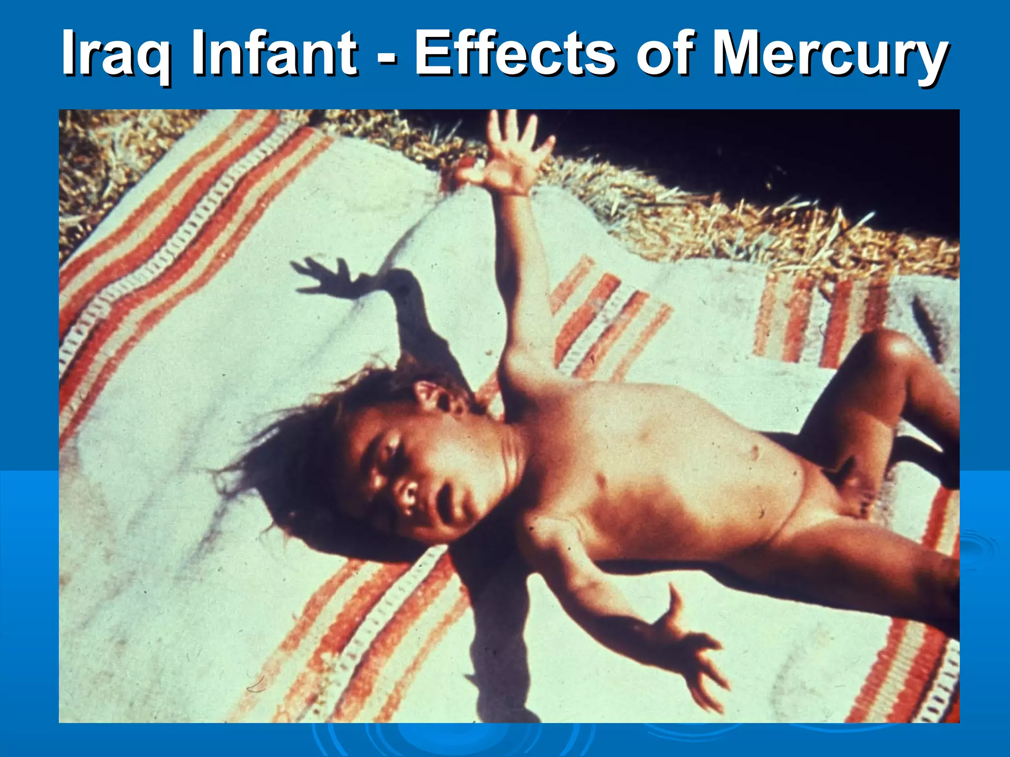 IIrraaqq IInnffaanntt -- EEffffeeccttss ooff MMeerrccuurryy 
 