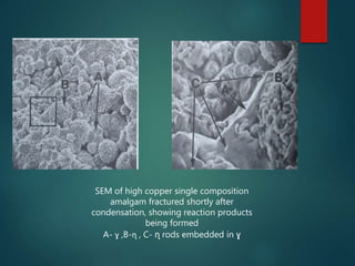 SEM of high copper single composition
amalgam fractured shortly after
condensation, showing reaction products
being formed
A- ɣ ,B-ɳ , C- ɳ rods embedded in ɣ
 