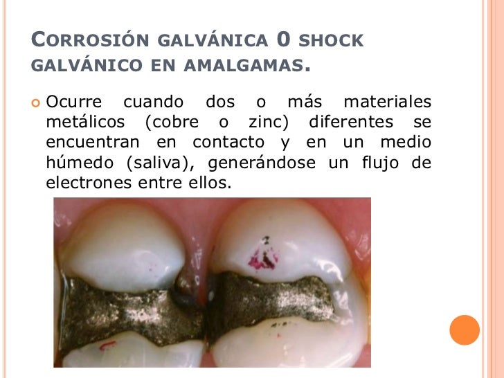 Amalgama dental