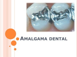 Amalgama dental 