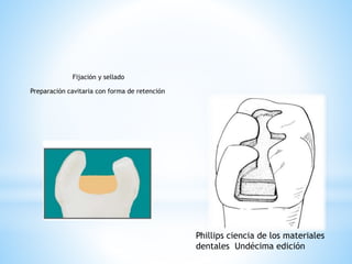 Fijación y sellado
Preparación cavitaria con forma de retención
Phillips ciencia de los materiales
dentales Undécima edición
 