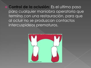    Control de la oclusión: Es el ultimo paso
    para cualquier maniobra operatoria que
    termina con una restauración, para que
    al ocluir no se produzcan contactos
    intercuspideos prematuros.
 