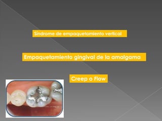 Síndrome de empaquetamiento vertical




Empaquetamiento gingival de la amalgama



                  Creep o Flow
 