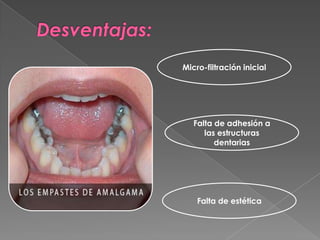 Micro-filtración inicial




   Falta de adhesión a
      las estructuras
         dentarias




    Falta de estética
 