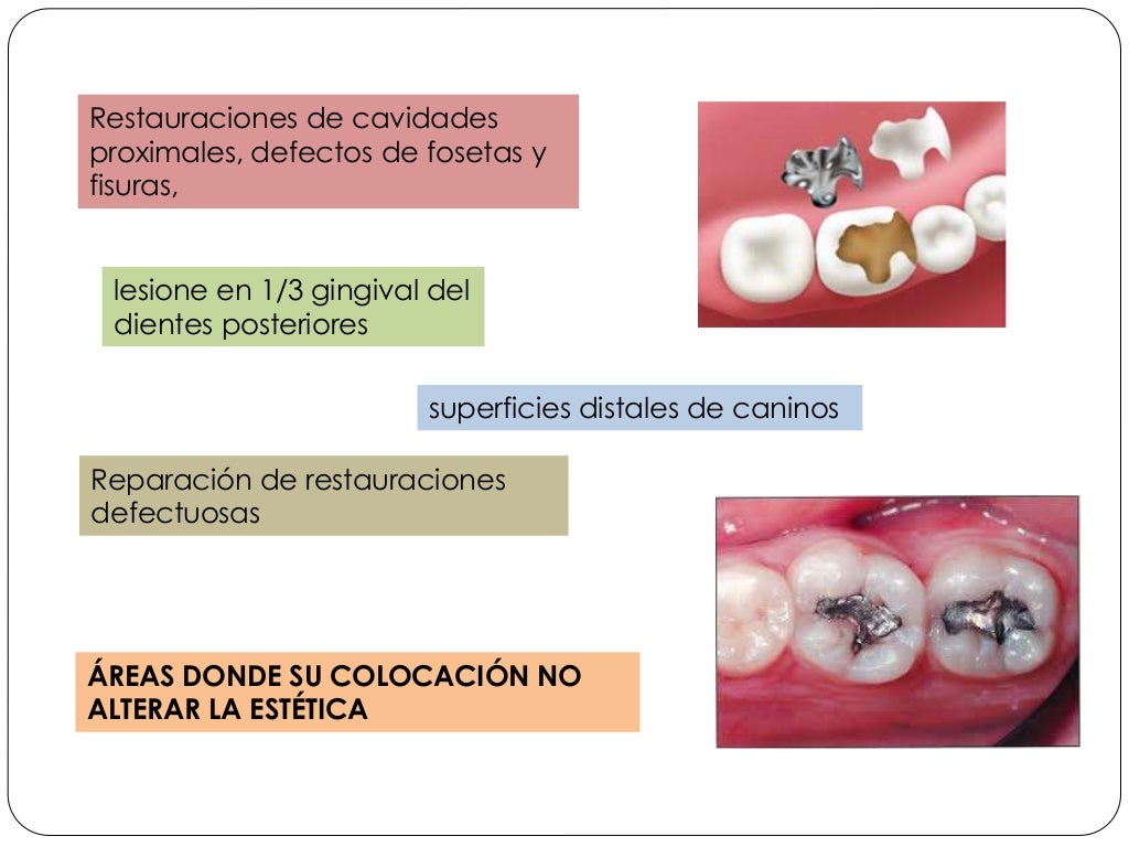 Amalgamas dentales