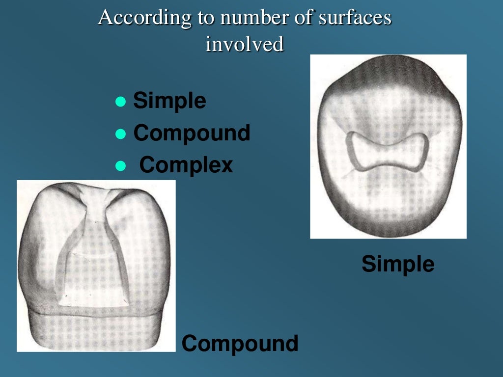 Amalgam cavity design
