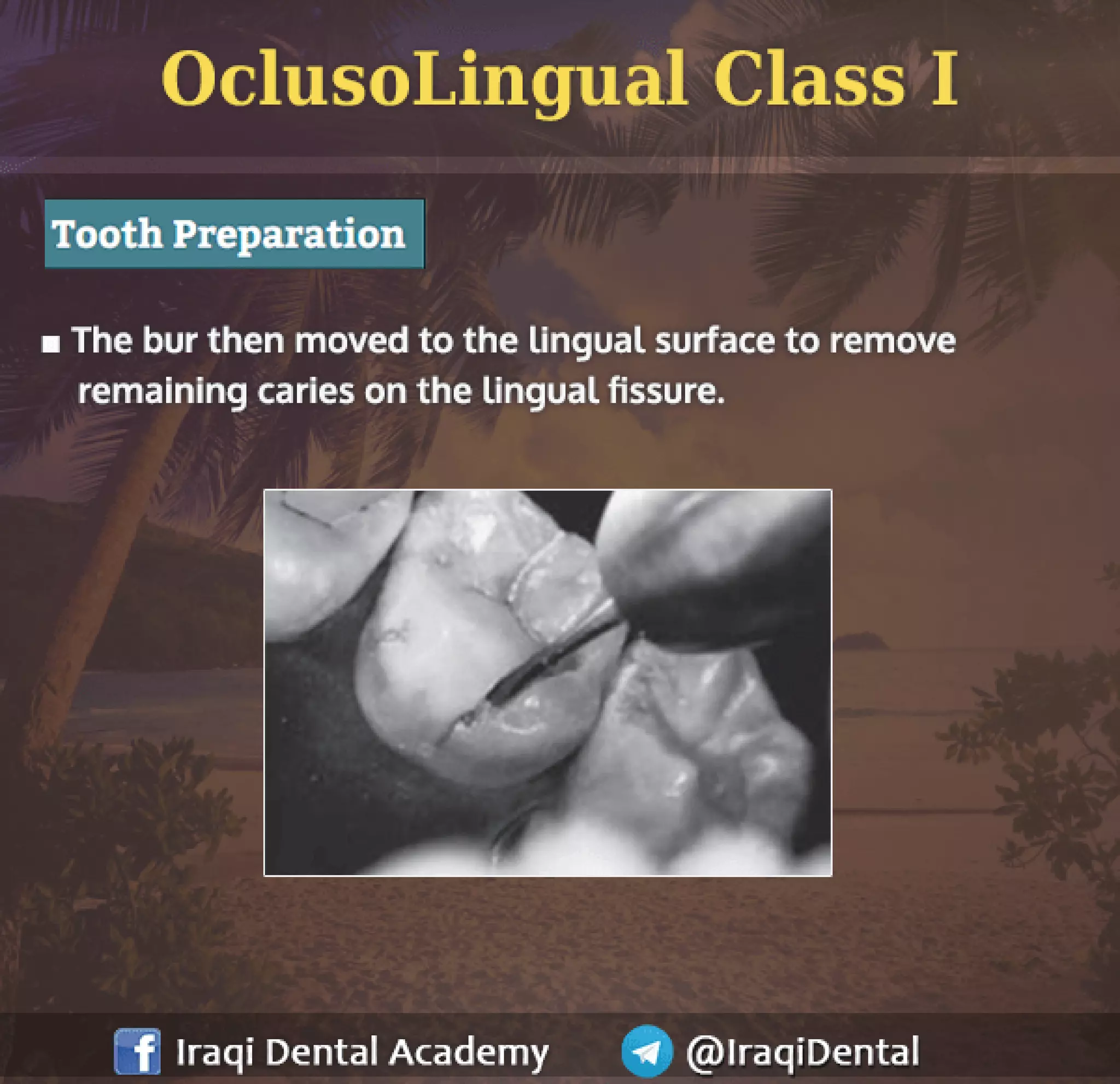 Amalgam Class I Restoration Explained | PDF