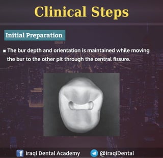 Amalgam Class I Restoration Explained | PDF