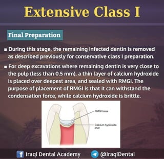 Amalgam Class I Restoration Explained | PDF