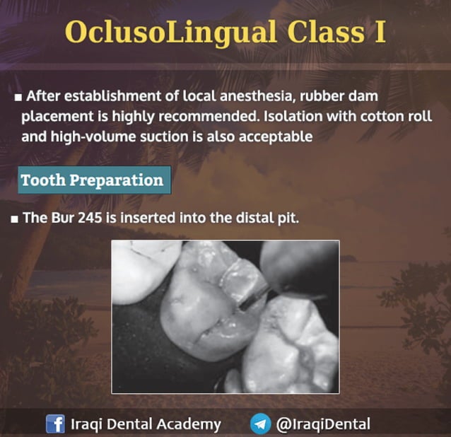 Amalgam Class I Restoration Explained