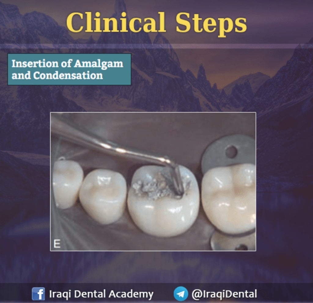 Amalgam Class I Restoration Explained
