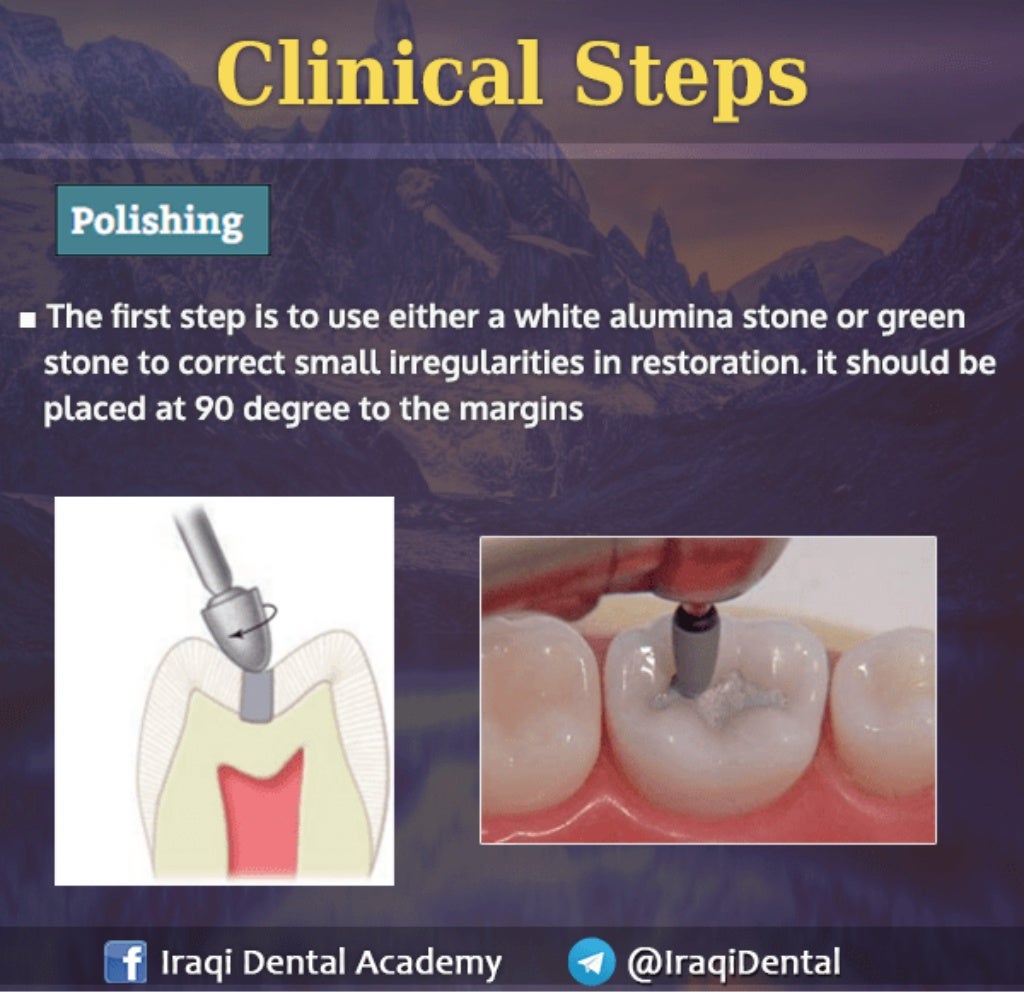 Amalgam Class I Restoration Explained