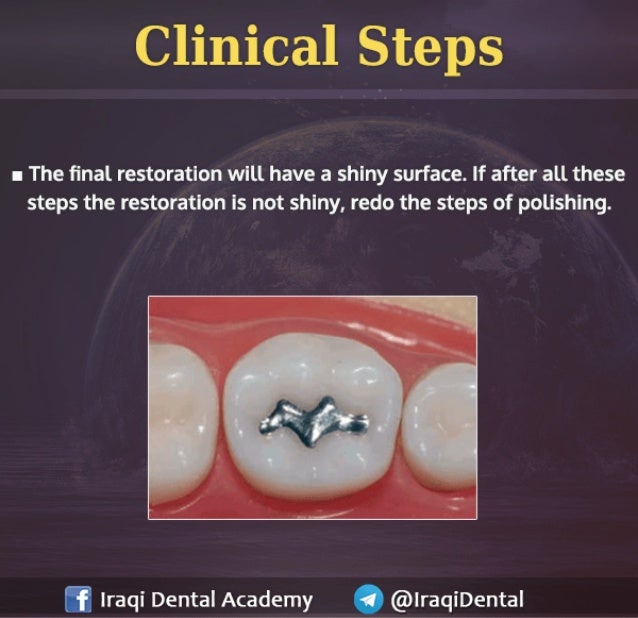 Amalgam Class I Restoration Explained