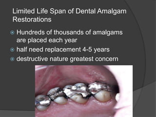 Limited Life Span of Dental Amalgam
Restorations
 Hundreds of thousands of amalgams
are placed each year
 half need replacement 4-5 years
 destructive nature greatest concern
 