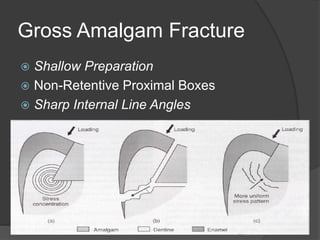 Gross Amalgam Fracture
 Shallow Preparation
 Non-Retentive Proximal Boxes
 Sharp Internal Line Angles
 