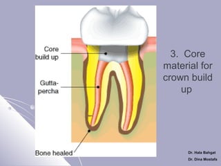 3. Core
material for
crown build
up

Dr. Hala Bahgat
Dr. Dina Mostafa

 