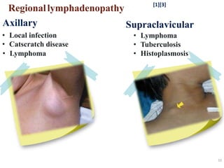 10
Regionallymphadenopathy
Axillary
• Local infection
• Catscratch disease
• Lymphoma
Supraclavicular
• Lymphoma
• Tuberculosis
• Histoplasmosis
[1][3]
 