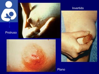 Protruso
Plano
Invertido
 