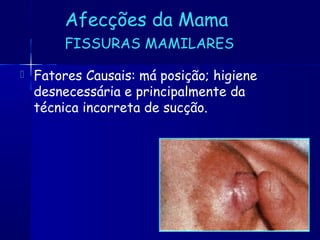 Afecções da Mama
FISSURAS MAMILARES
 Fatores Causais: má posição; higiene
desnecessária e principalmente da
técnica incorreta de sucção.
 