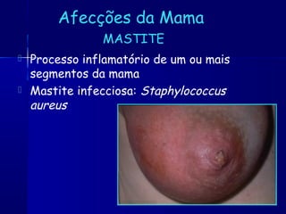 Afecções da Mama
MASTITE
 Processo inflamatório de um ou mais
segmentos da mama
 Mastite infecciosa: Staphylococcus
aureus
 