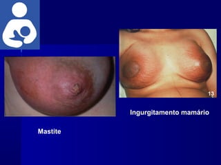 Mastite
Ingurgitamento mamário
 