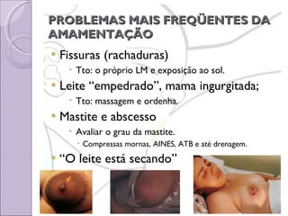 PROBLEMAS MAIS FREQÜENTES DA AMAMENTAÇÃO Fissuras (rachaduras) Tto: o próprio LM e exposição ao sol. Leite “empedrado”, mama ingurgitada; Tto: massagem e ordenha. Mastite e abscesso Avaliar o grau da mastite. Compressas mornas, AINES, ATB e até drenagem. “ O leite está secando” 
