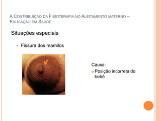 A CONTRIBUIÇÃO DA FISIOTERAPIA NO ALEITAMENTO MATERNO –
EDUCAÇÃO EM SAÚDE
 Fissura dos mamilos
Causa:
 Posição incorreta do
bebê
Situações especiais
 