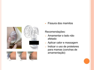  Fissura dos mamilos
Recomendações:
 Amamentar o lado não
afetado
 Aplicar calor e massagem
 Indicar o uso de protetores
para mamas (conchas de
amamentação)
 