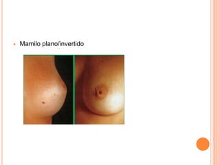  Mamilo plano/invertido
 