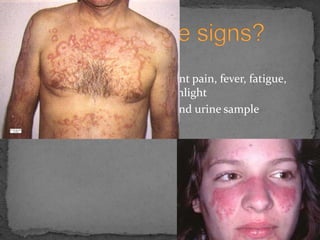 No incubation periodSigns/Symptoms: Arthritis, joint pain, fever, fatigue, skin rash, and sensitivity to sunlightDetected by blood cell count and urine sampleWhat are the signs?