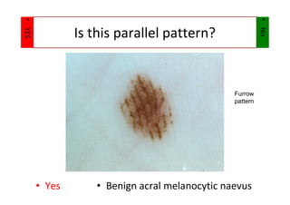 Amanda Oakley Dermoscopy presentation.pdf