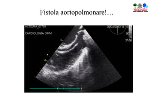 Fistola aortopolmonare!…
 