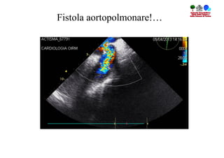 Fistola aortopolmonare!…
 