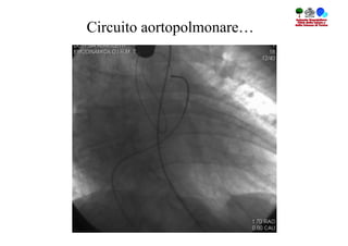 Circuito aortopolmonare…
 