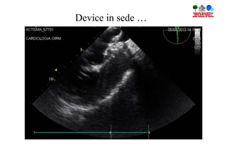 Device in sede …
 