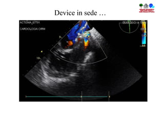 Device in sede …
 