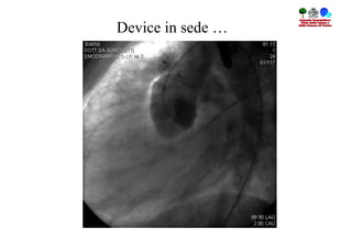 Device in sede …
 