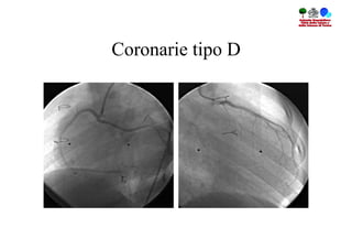 Coronarie tipo D
 