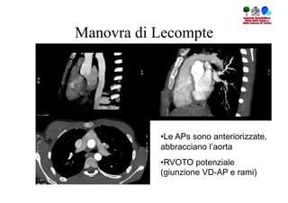 Manovra di Lecompte




           • Le APs sono anteriorizzate,
           abbracciano l’aorta
           • RVOTO potenziale
           (giunzione VD-AP e rami)
 