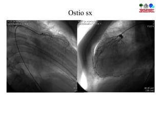 Ostio sx
 