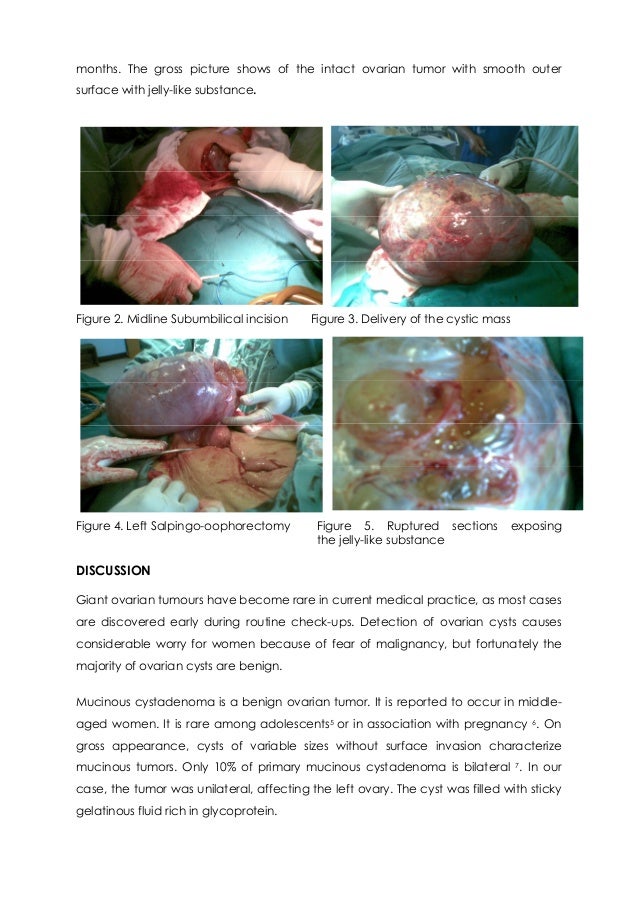 a massive cystic adenoma