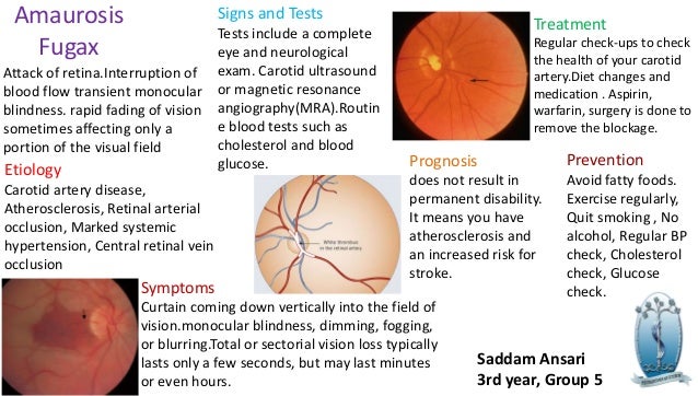 Amaurosis fugax