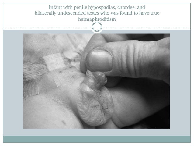 hermaphroditism