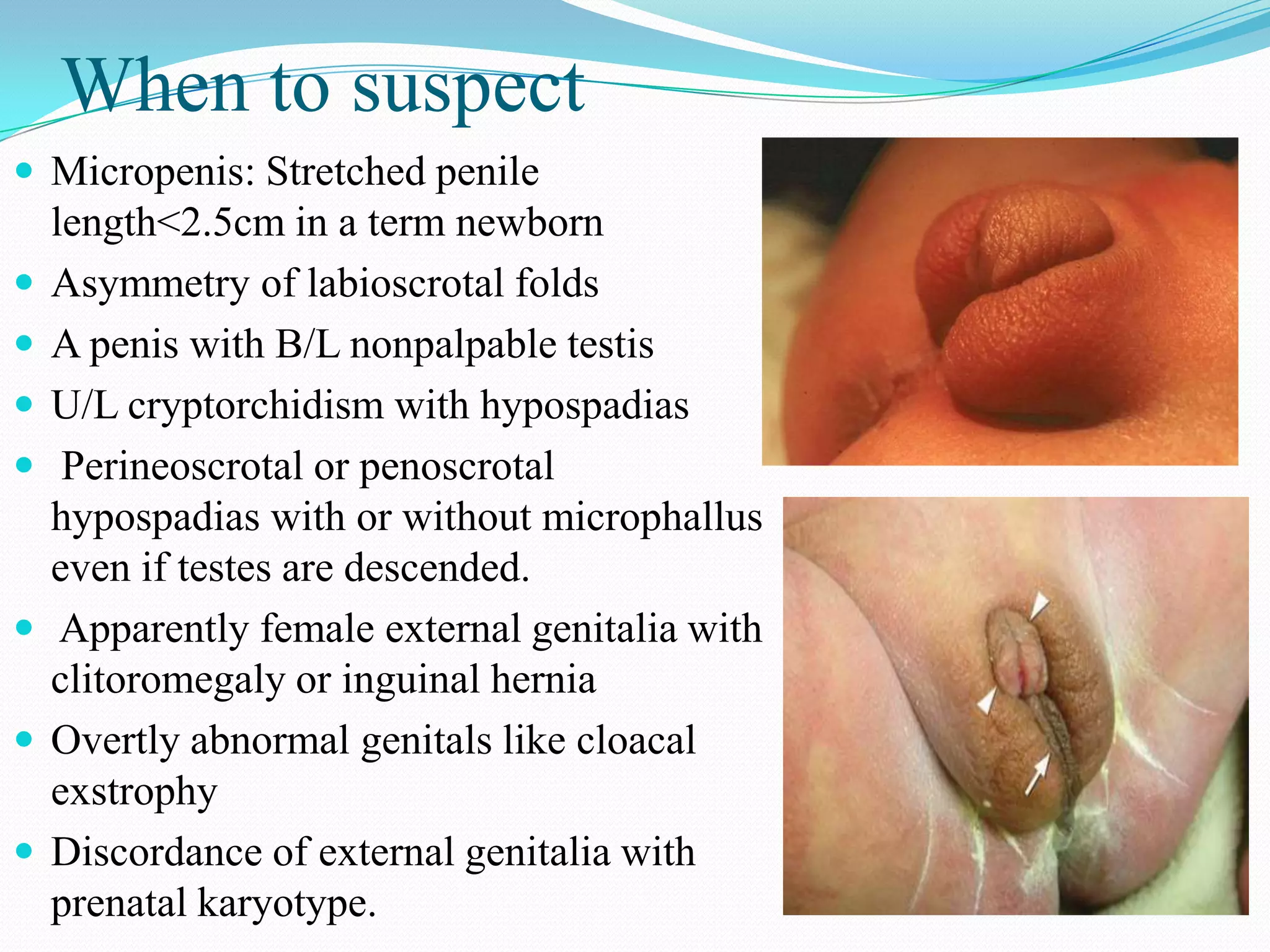 When to suspect
 Micropenis: Stretched penile










length<2.5cm in a term newborn
Asymmetry of labioscrotal folds
A penis with B/L nonpalpable testis
U/L cryptorchidism with hypospadias
Perineoscrotal or penoscrotal
hypospadias with or without microphallus
even if testes are descended.
Apparently female external genitalia with
clitoromegaly or inguinal hernia
Overtly abnormal genitals like cloacal
exstrophy
Discordance of external genitalia with
prenatal karyotype.

 