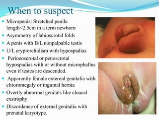 Types Of Ambiguous Genitalia