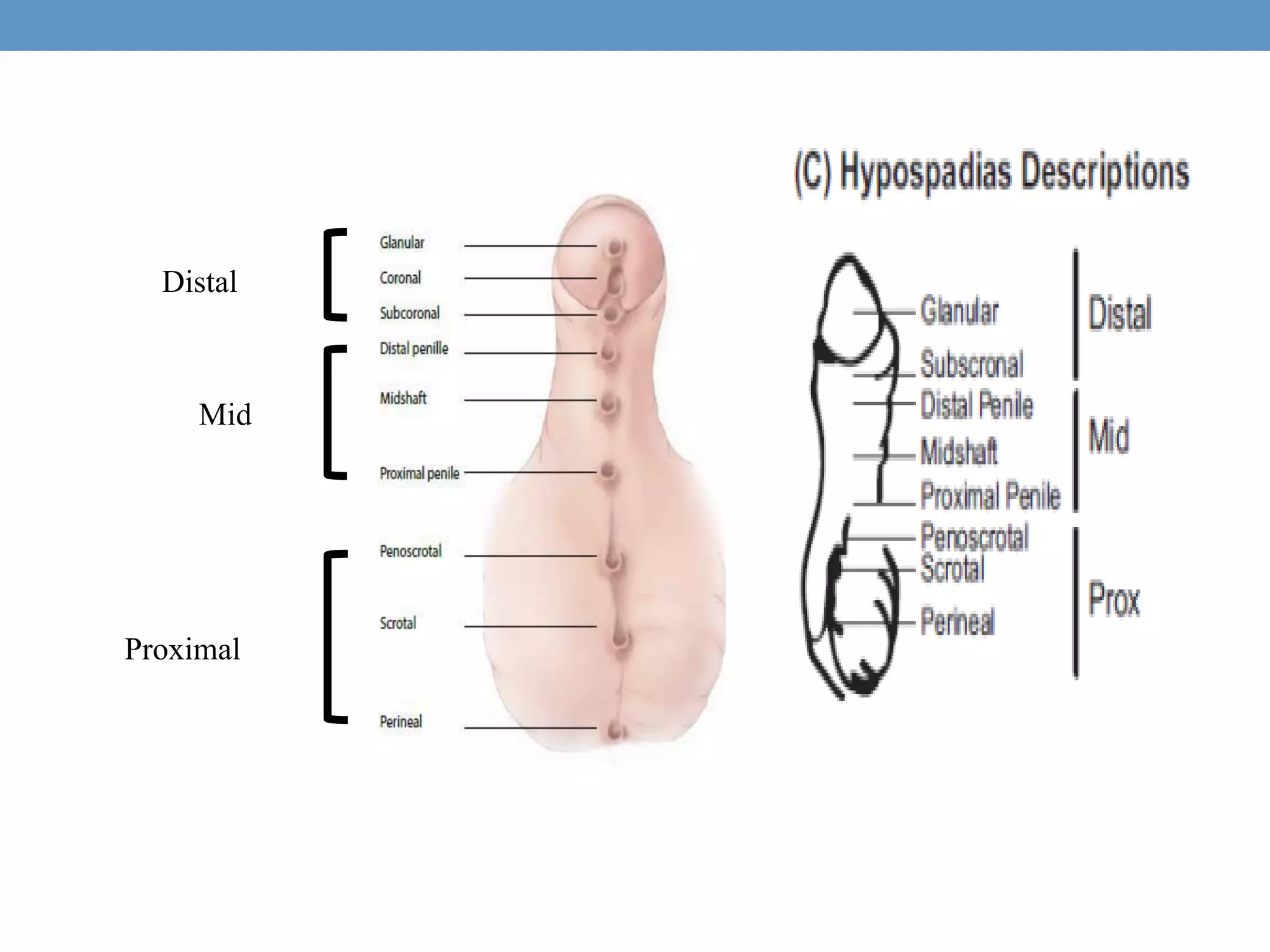Distal
Mid
Proximal
 