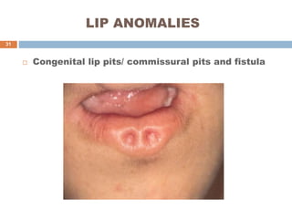 LIP ANOMALIES
 Congenital lip pits/ commissural pits and fistula
31
 